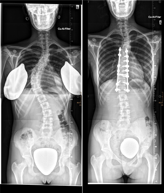 Skoliose_Spondylodese